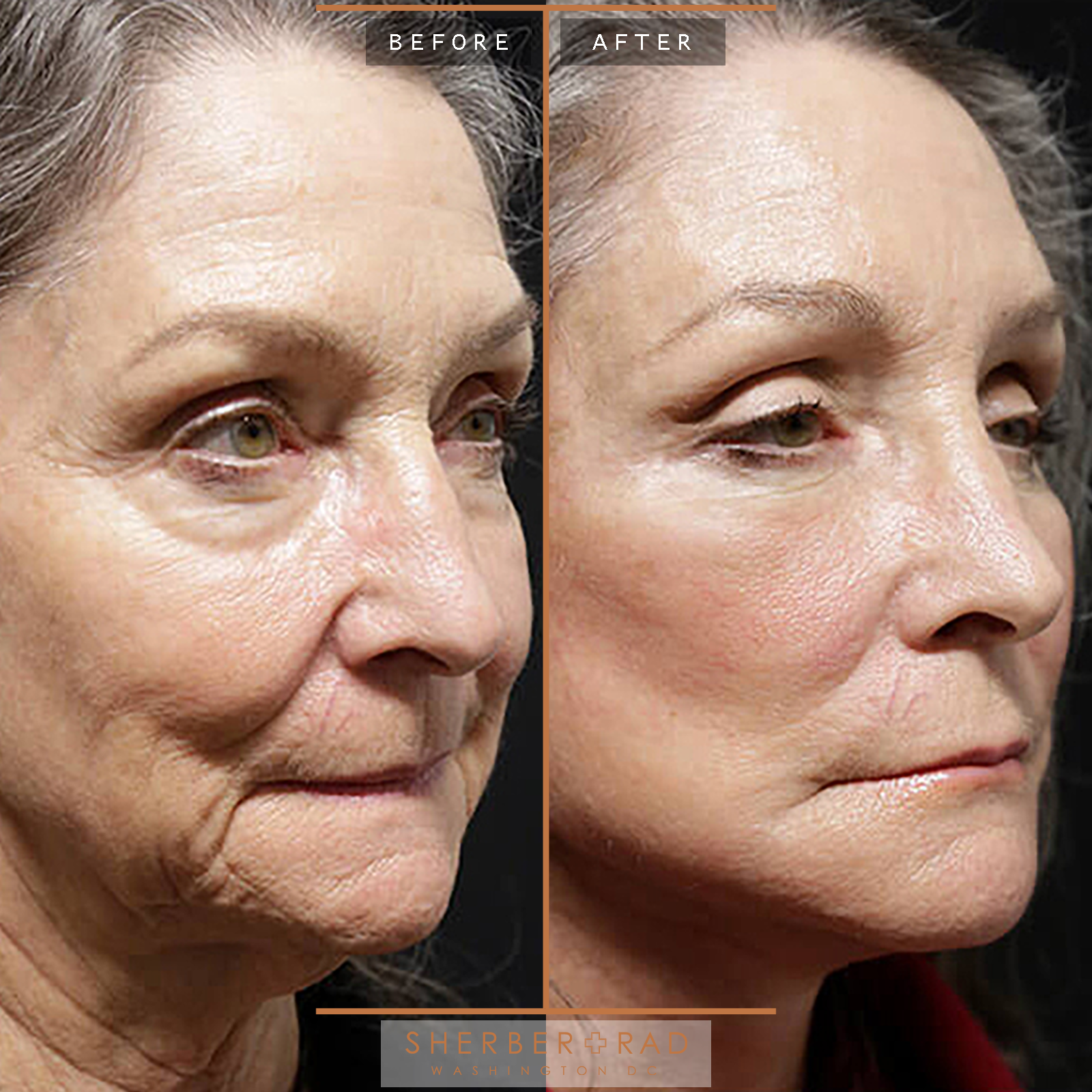 Facelift before and after photos by Sherber and Rad in Washington, DC