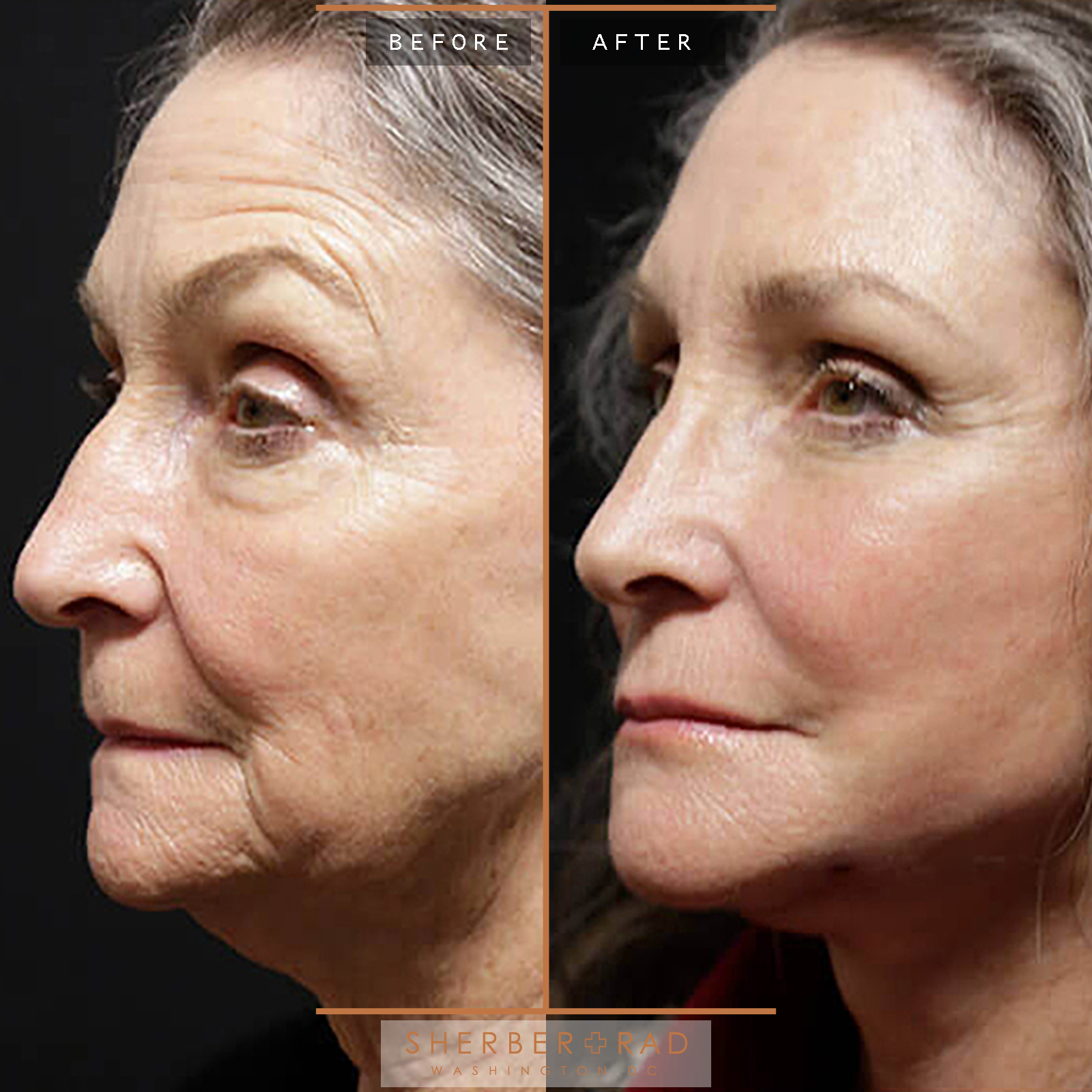 Facelift before and after photos by Sherber and Rad in Washington, DC