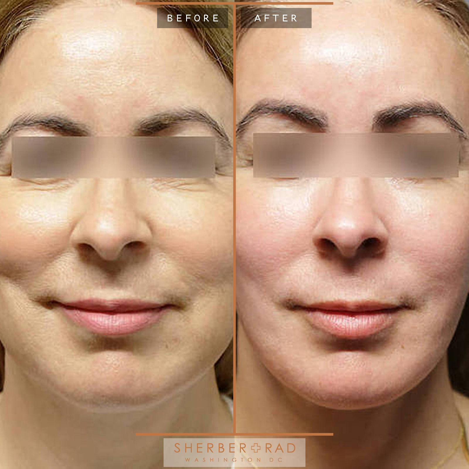 Facelift before and after photos by Sherber and Rad in Washington, DC