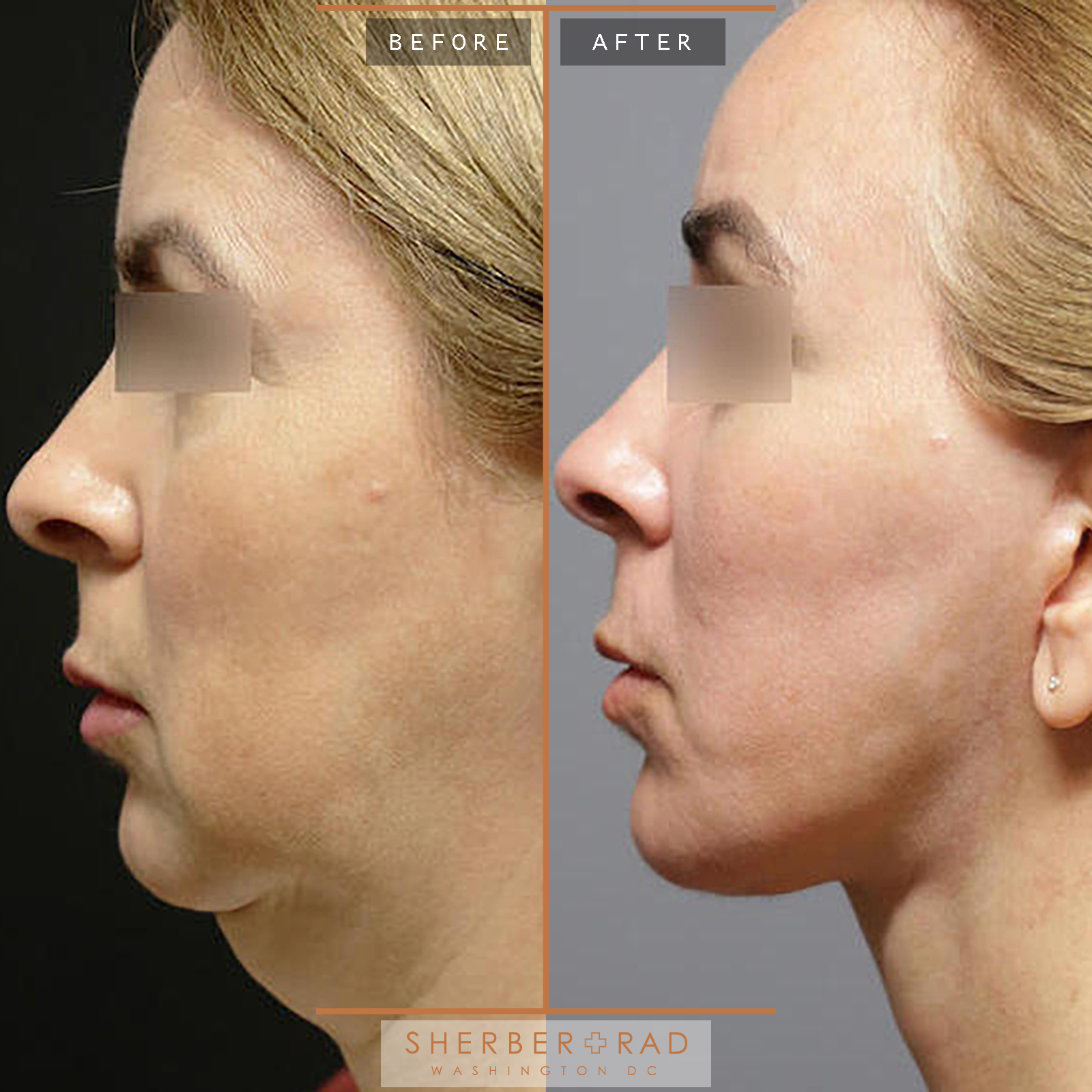 Facelift before and after photos by Sherber and Rad in Washington, DC