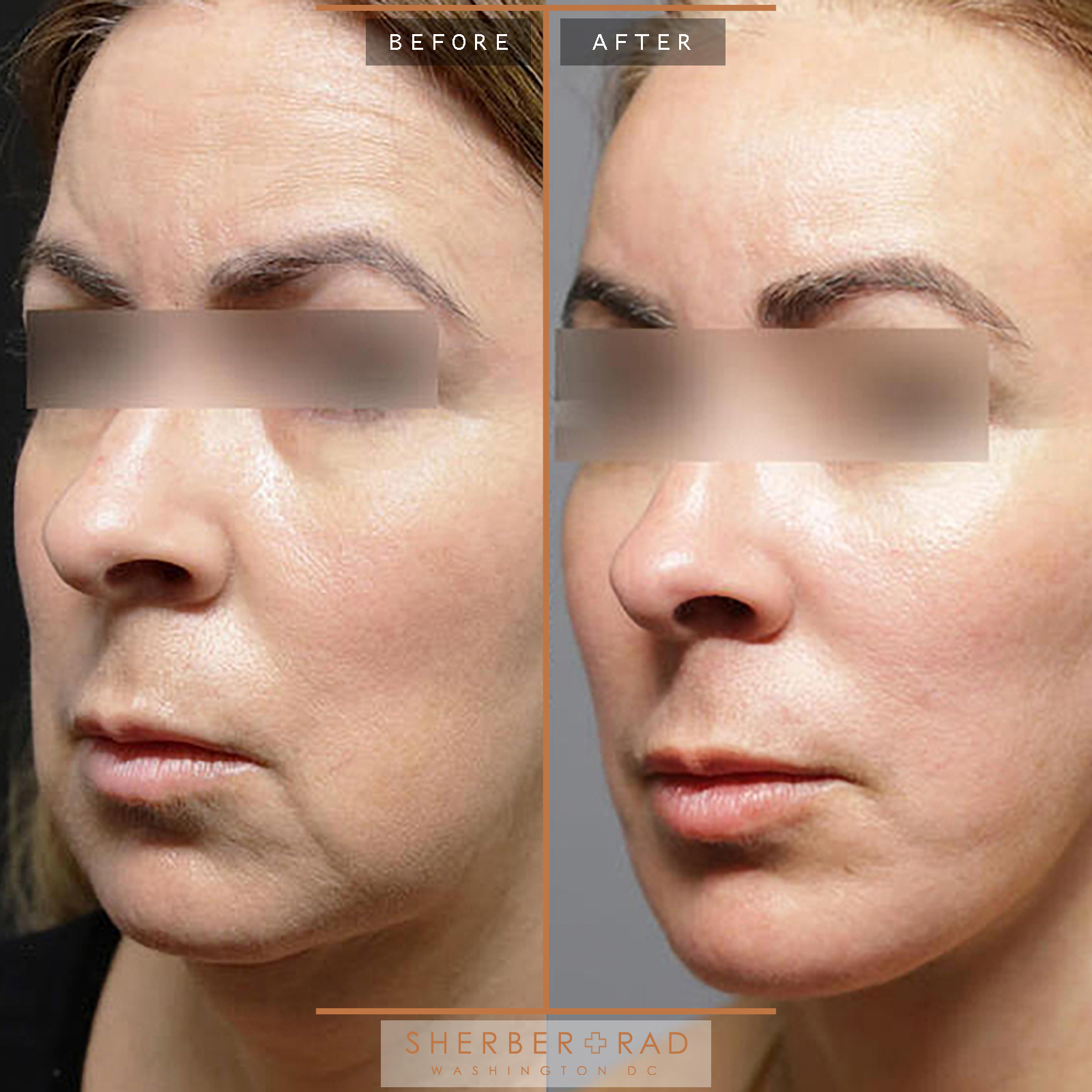 Facelift before and after photos by Sherber and Rad in Washington, DC