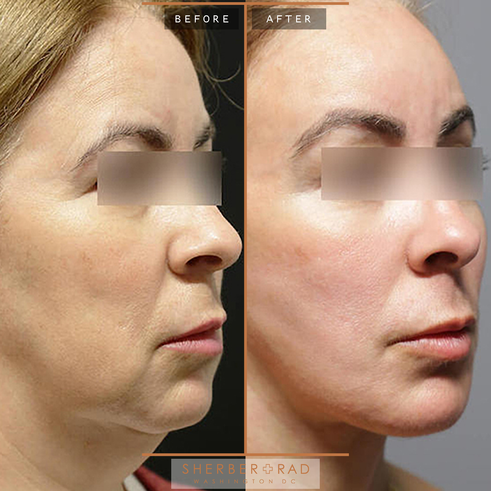 Facelift before and after photos by Sherber and Rad in Washington, DC