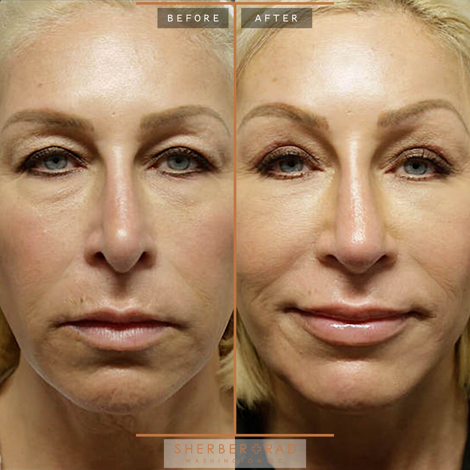 Facelift before and after photos by Sherber and Rad in Washington, DC