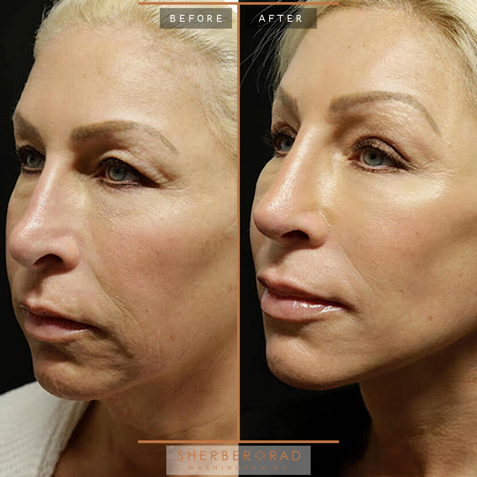 Facelift before and after photos by Sherber and Rad in Washington, DC