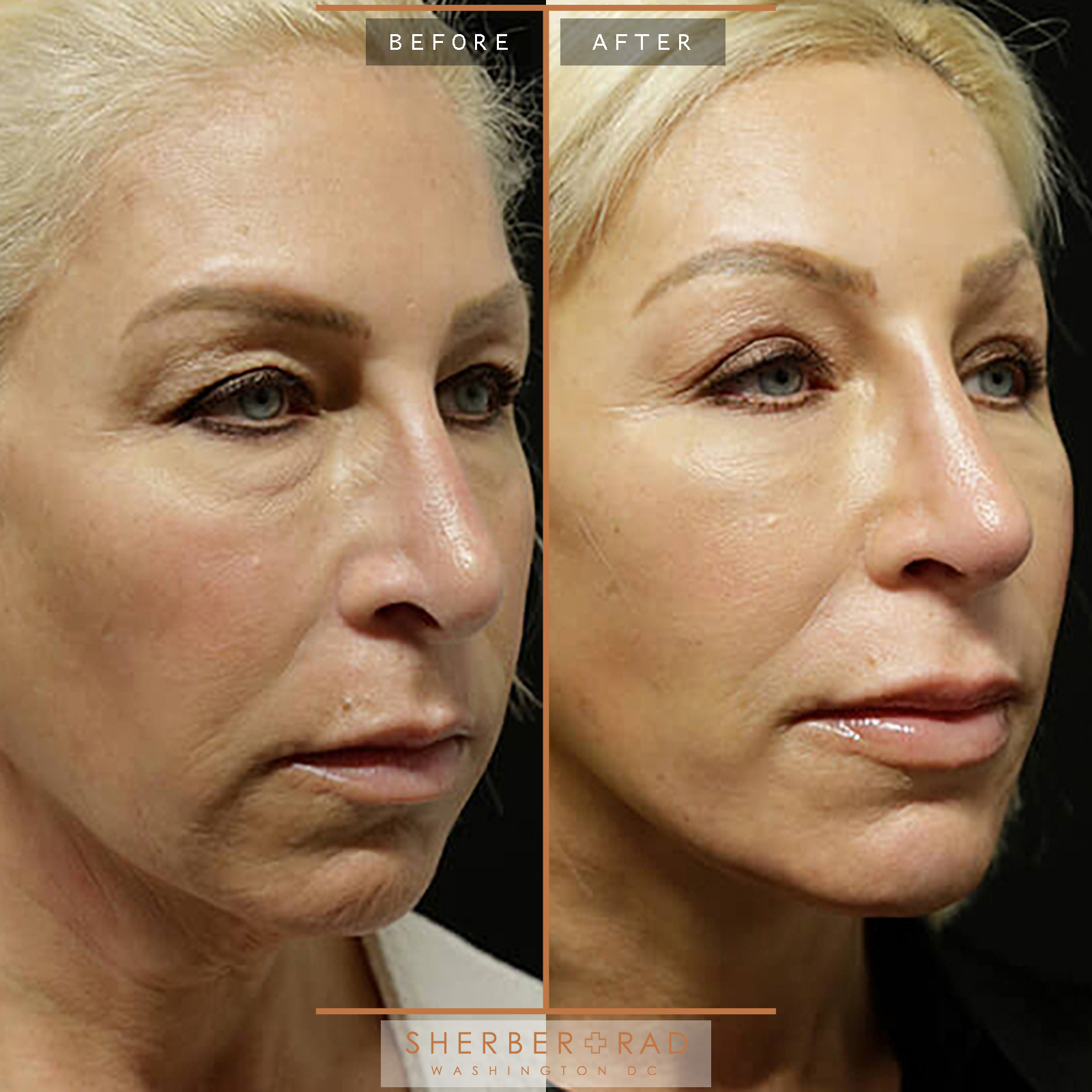 Facelift before and after photos by Sherber and Rad in Washington, DC