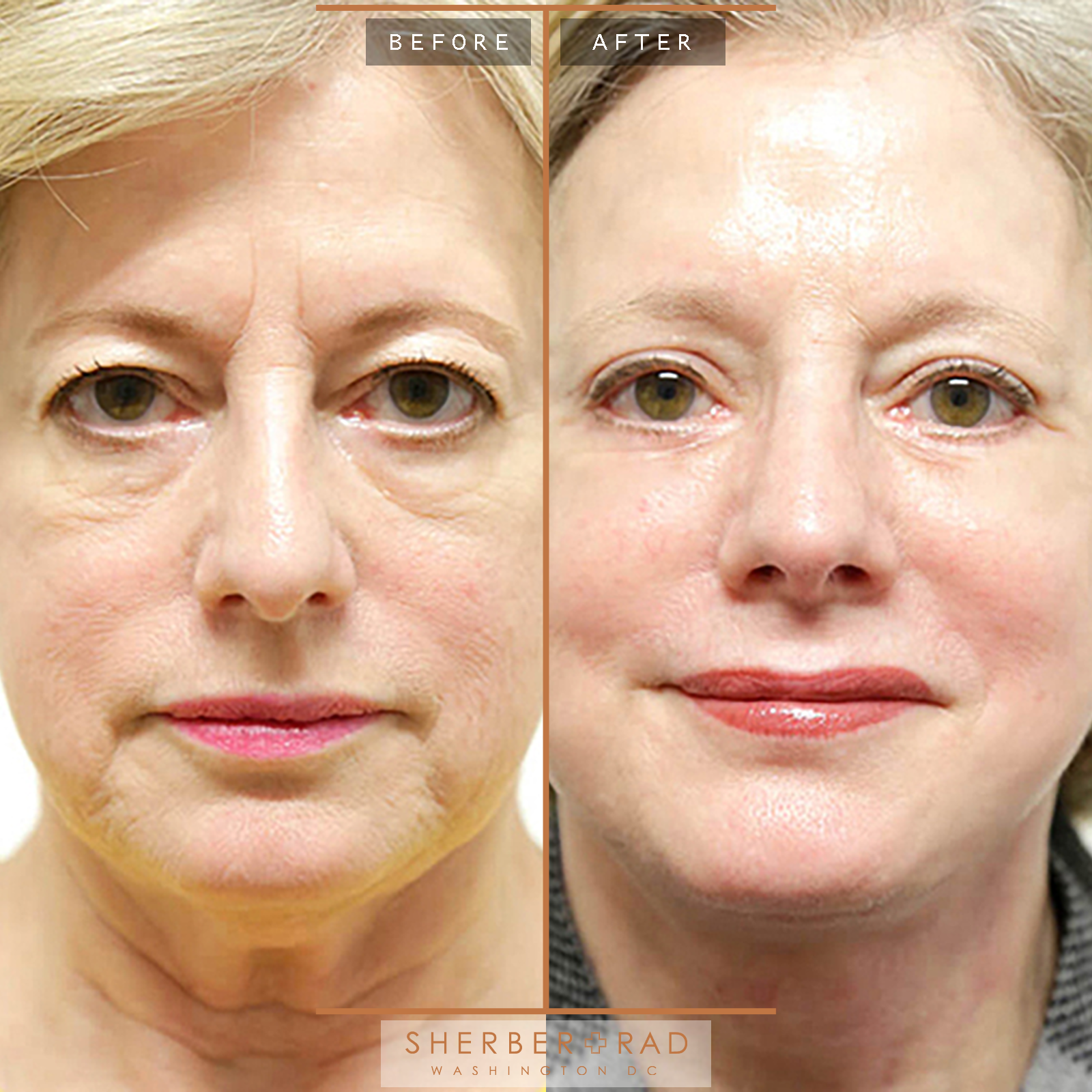 Facelift before and after photos by Sherber and Rad in Washington, DC