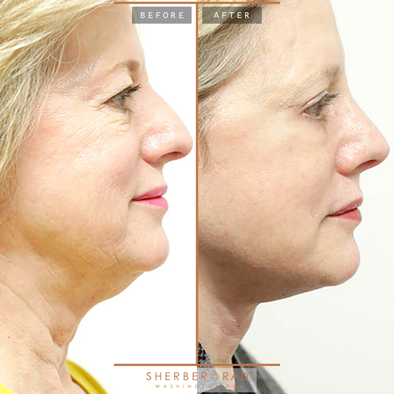 Facelift before and after photos by Sherber and Rad in Washington, DC