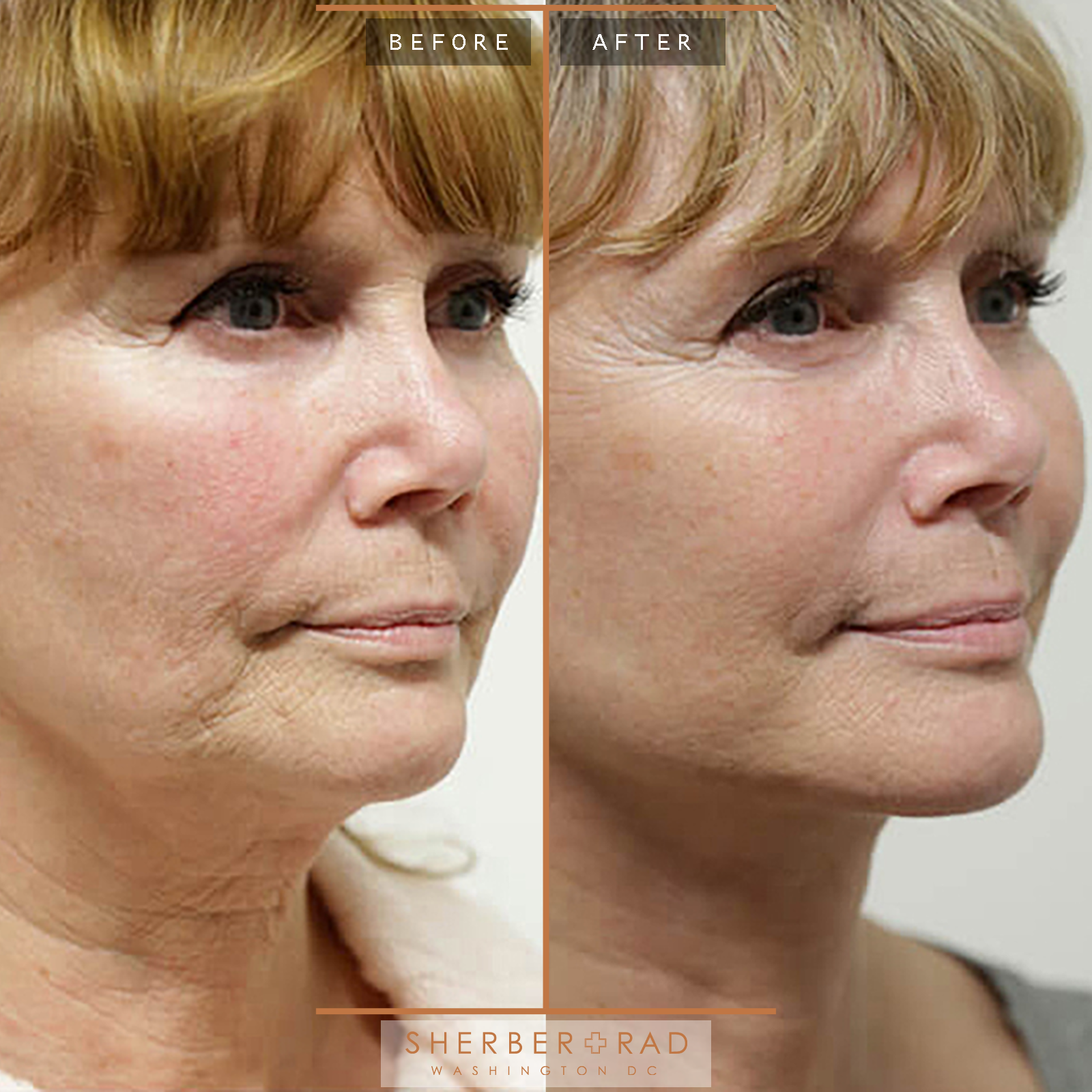 Facelift before and after photos by Sherber and Rad in Washington, DC