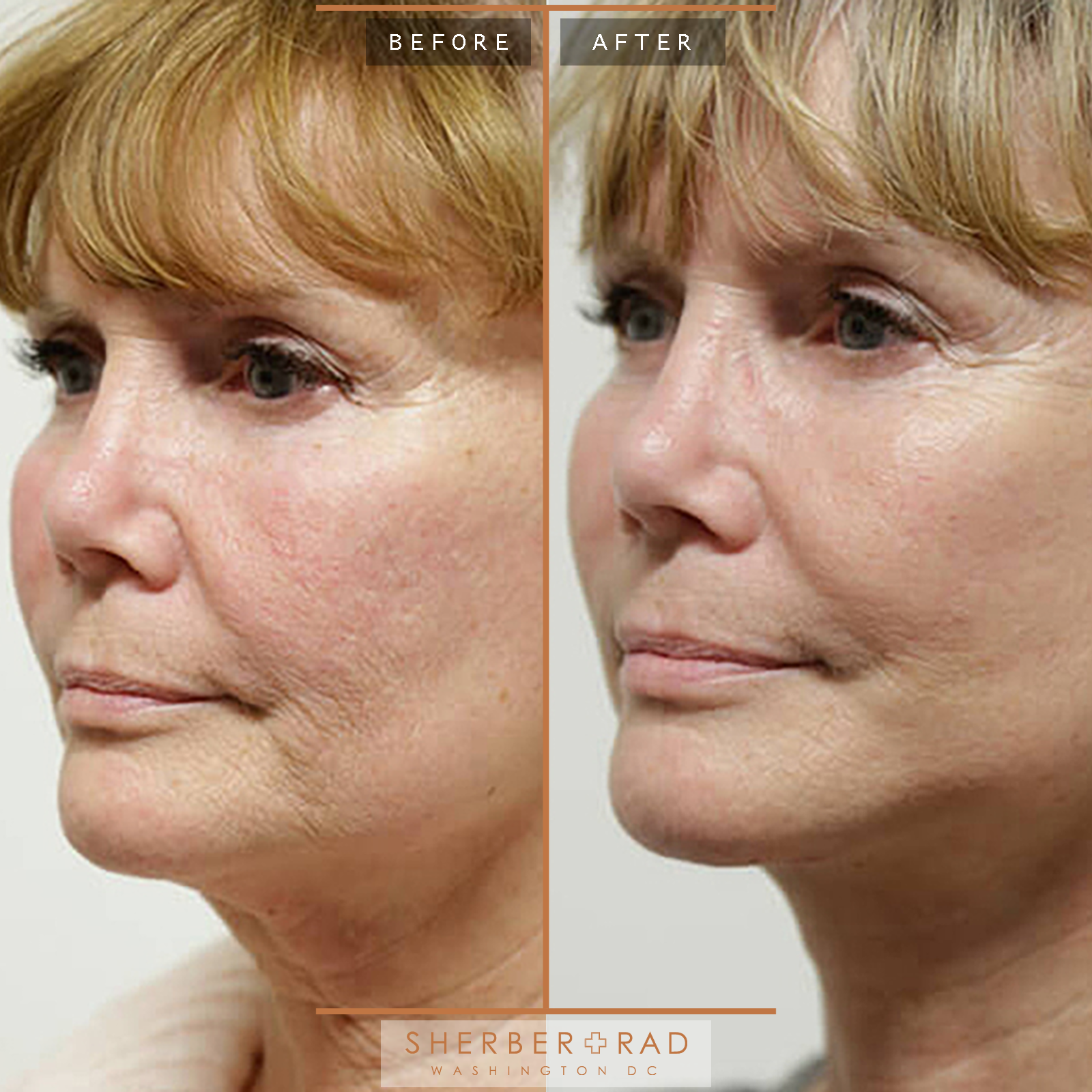 Facelift before and after photos by Sherber and Rad in Washington, DC