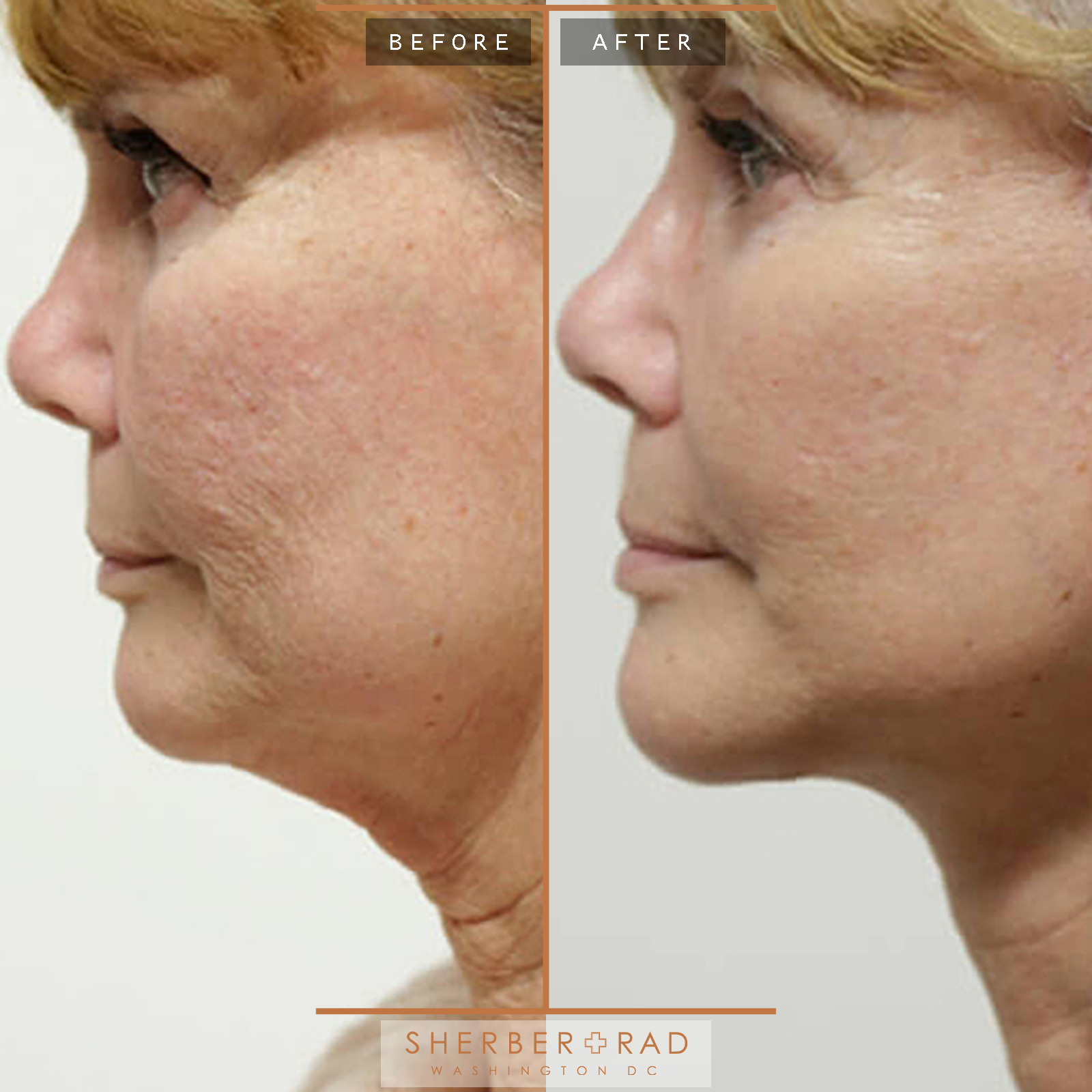 Facelift before and after photos by Sherber and Rad in Washington, DC