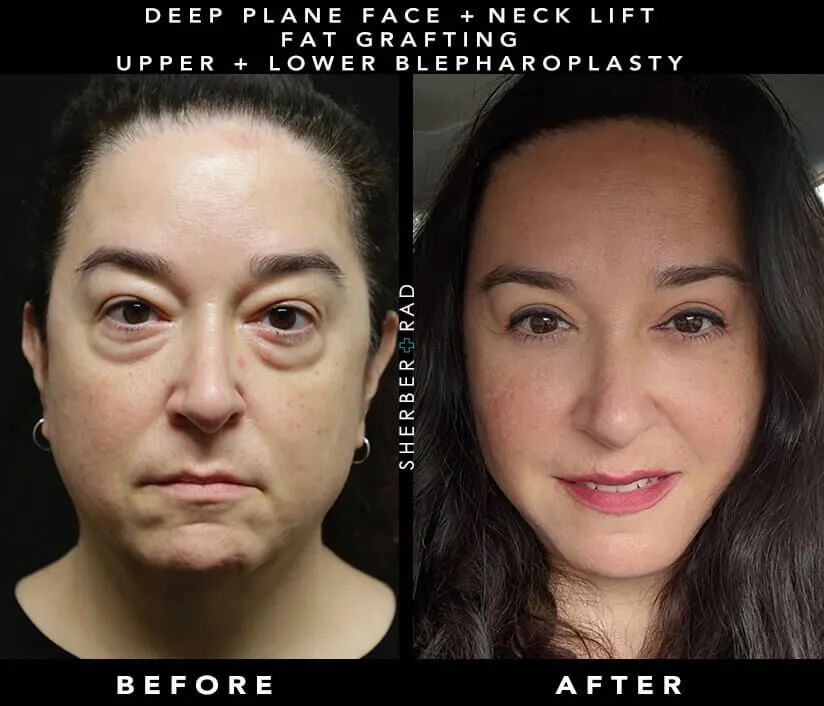 facelift before and after photos by sherber and rad in washington