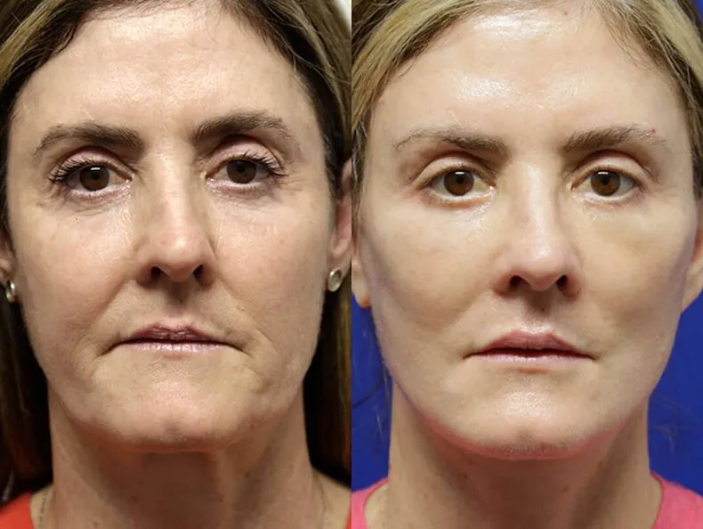 Facelift before and after photos by Sherber and Rad in Washington, DC
