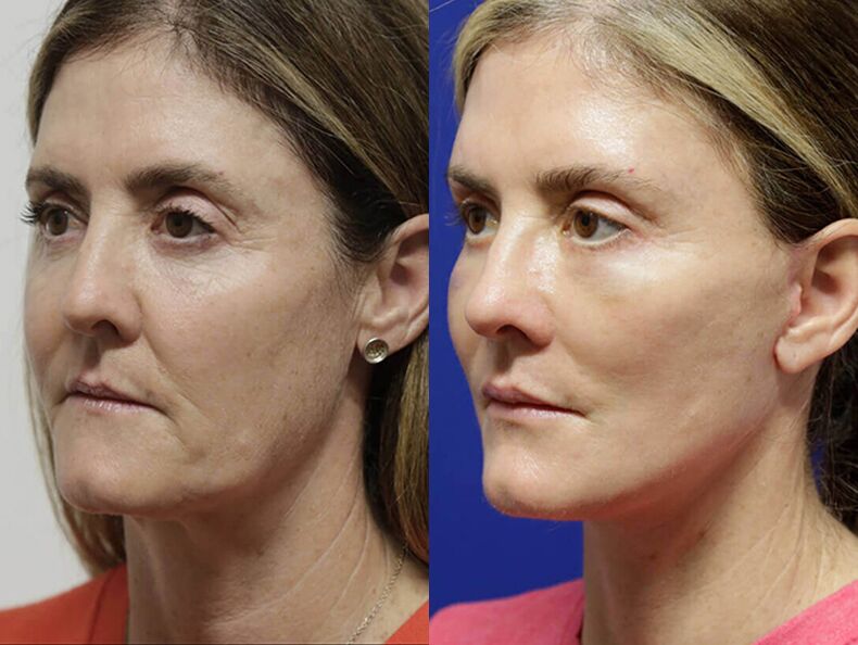 Facelift before and after photos by Sherber and Rad in Washington, DC