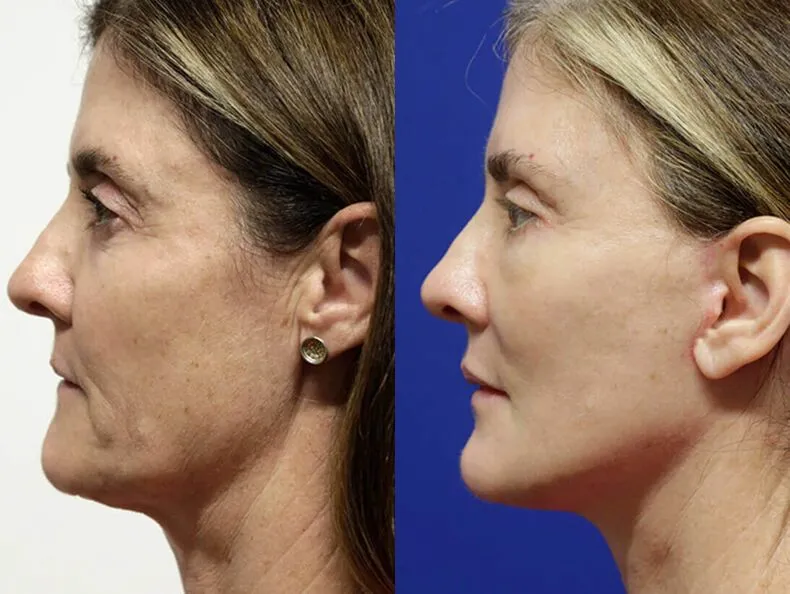 Facelift before and after photos by Sherber and Rad in Washington, DC