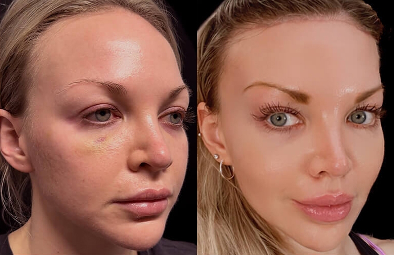 Facelift before and after photos by Sherber and Rad in Washington, DC