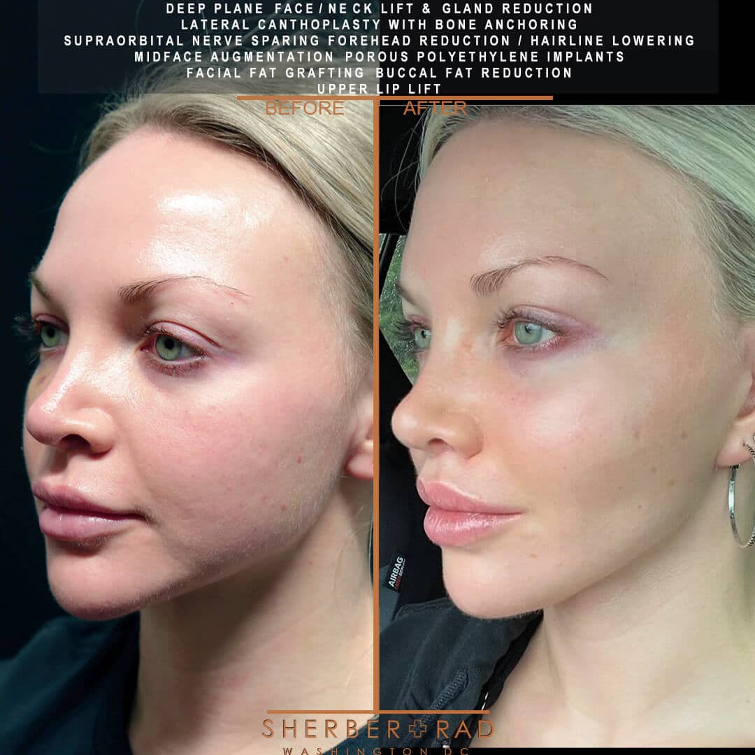 Deep Plane Facelift before and after photos by Sherber and Rad in Washington