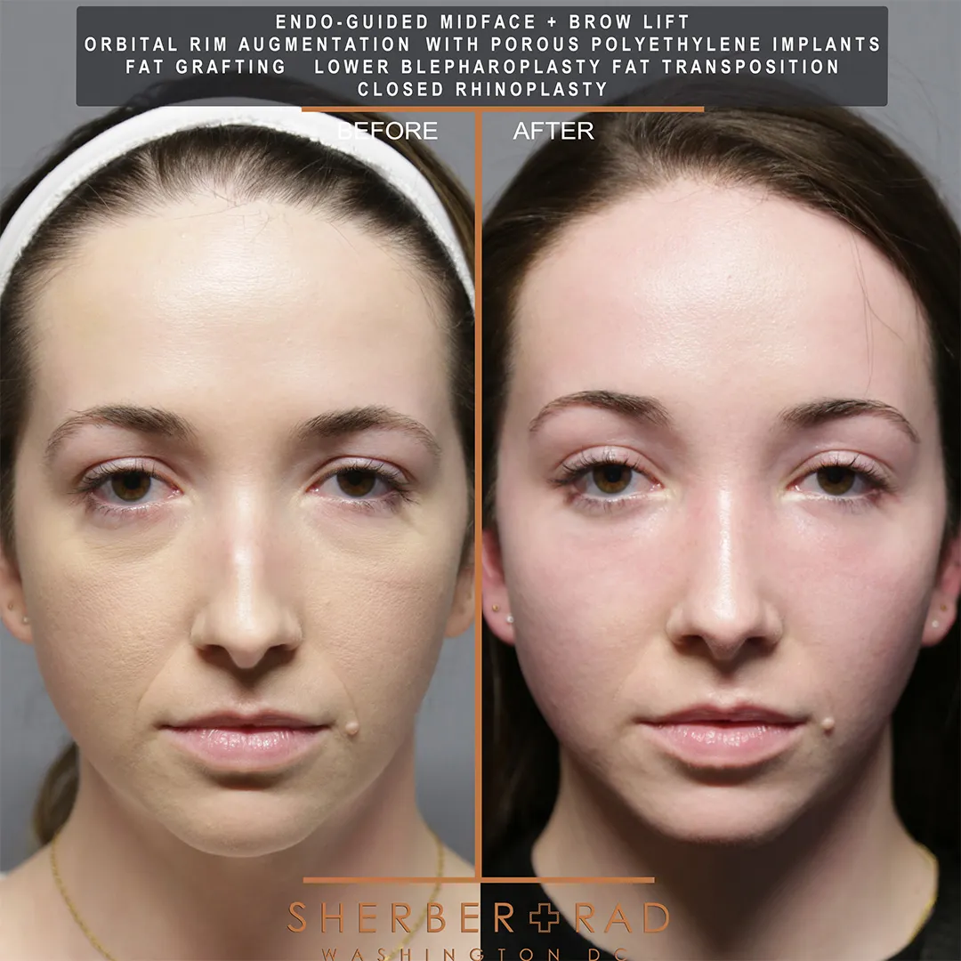 Facial Optimization before and after photos by Sherber and Rad in Washington DC