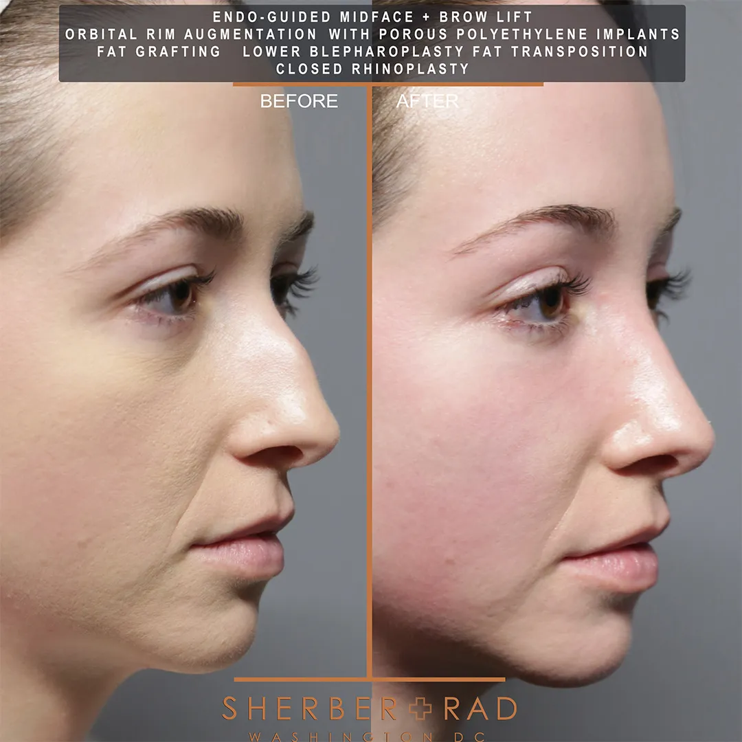 Facial Optimization before and after photos by Sherber and Rad in Washington DC