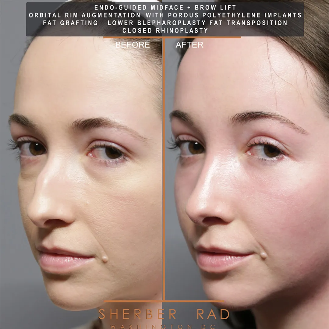Facial Optimization before and after photos by Sherber and Rad in Washington DC