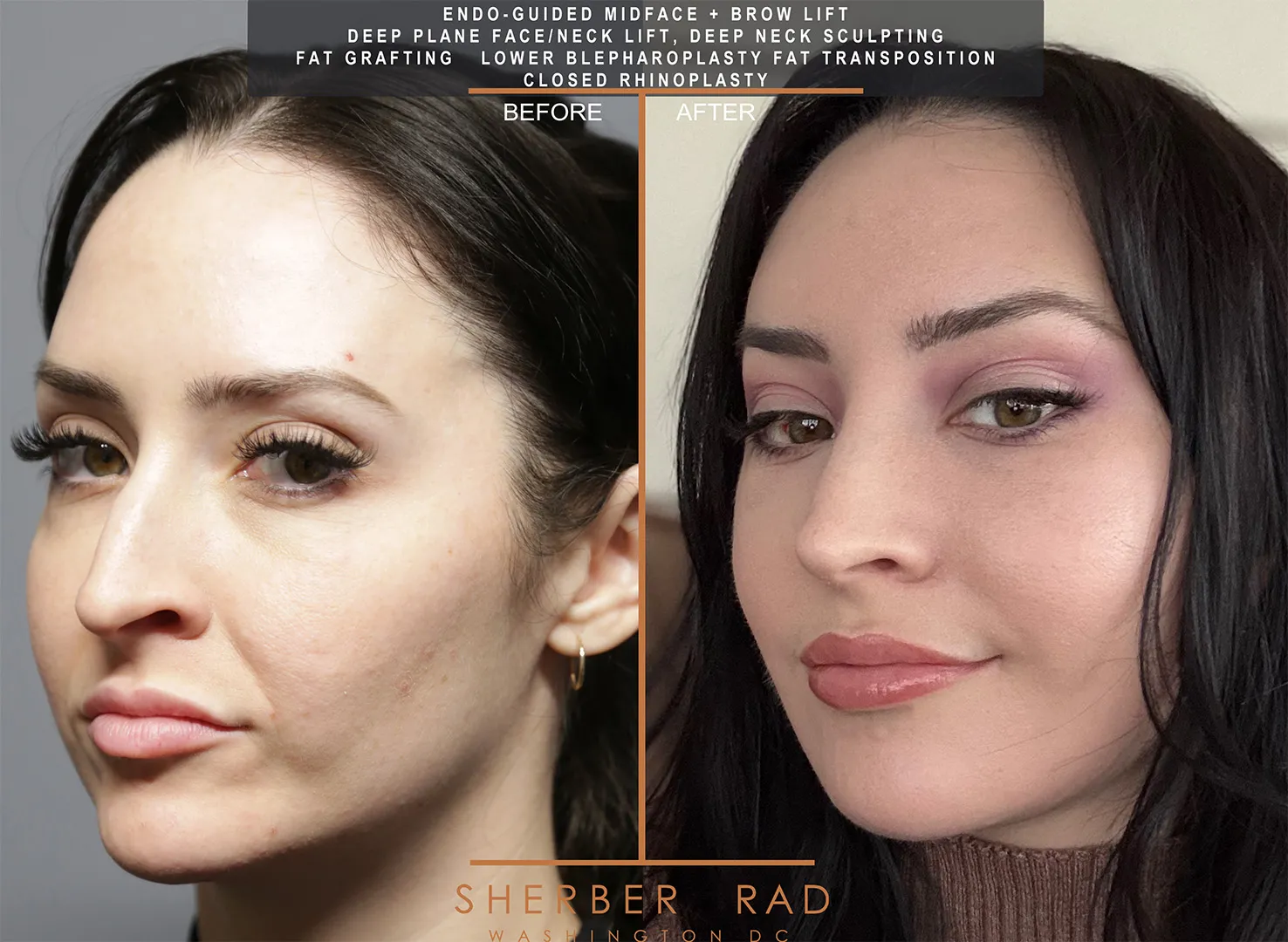 Facial Optimization before and after photos by Sherber and Rad in Washington DC