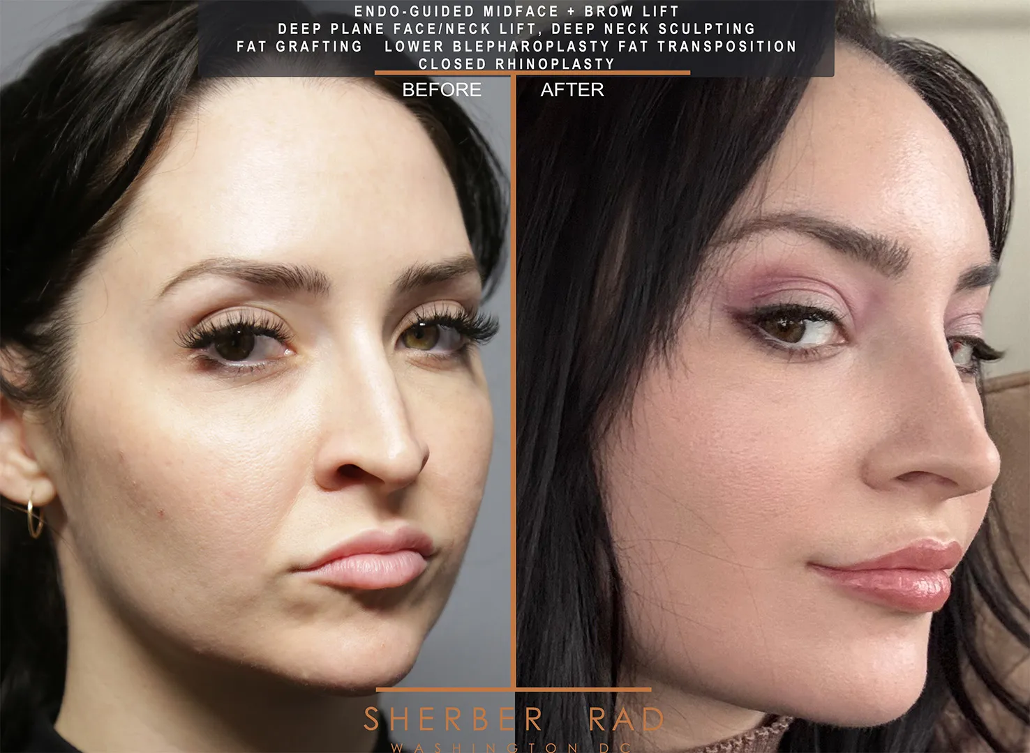 Facial Optimization before and after photos by Sherber and Rad in Washington DC