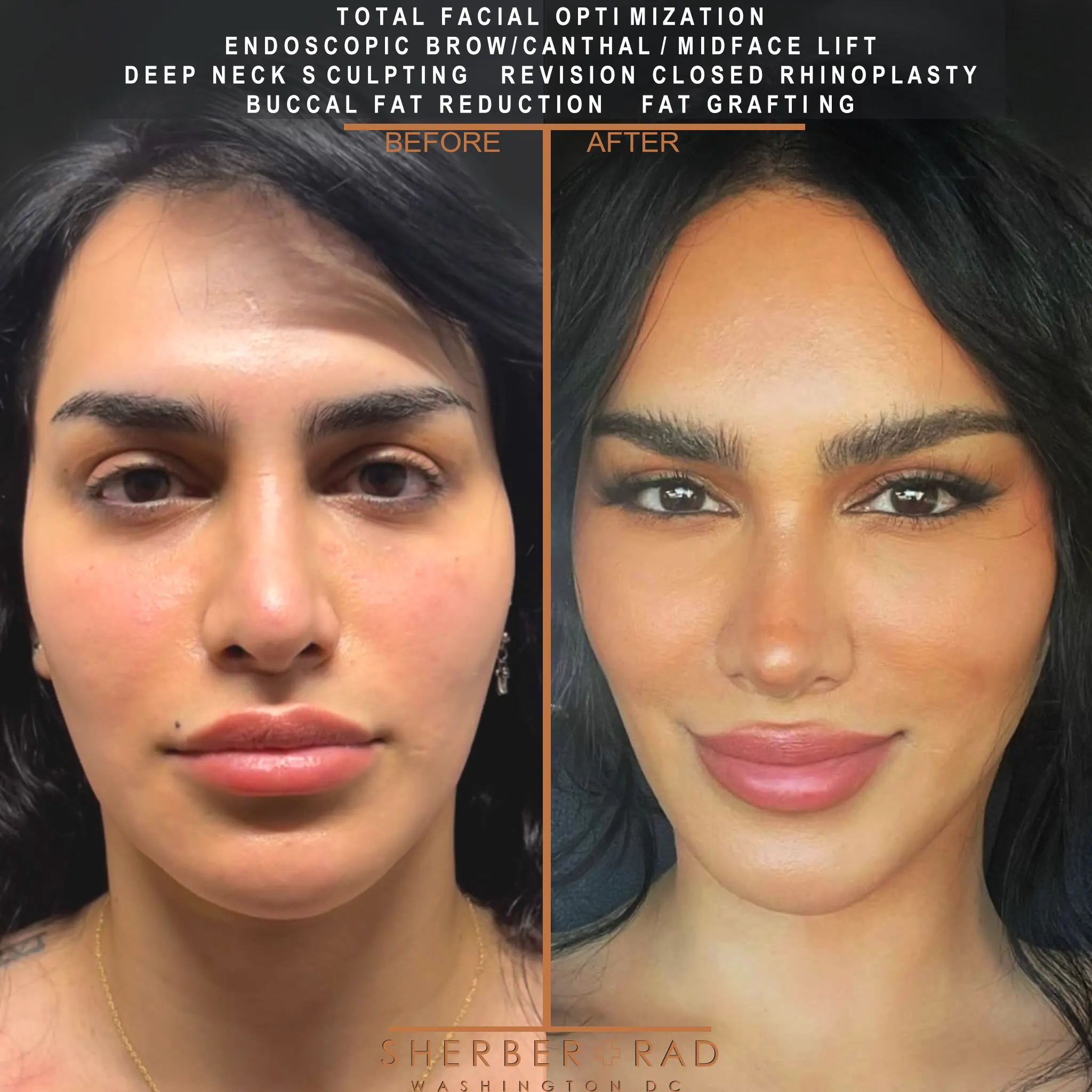 Facial Optimization before and after photos by Sherber and Rad in Washington DC
