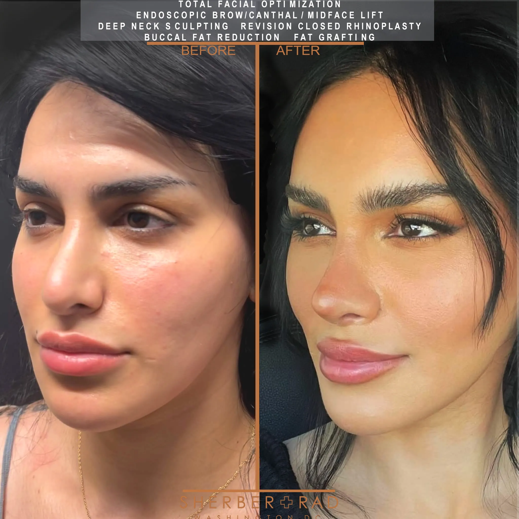 Facial Optimization before and after photos by Sherber and Rad in Washington DC