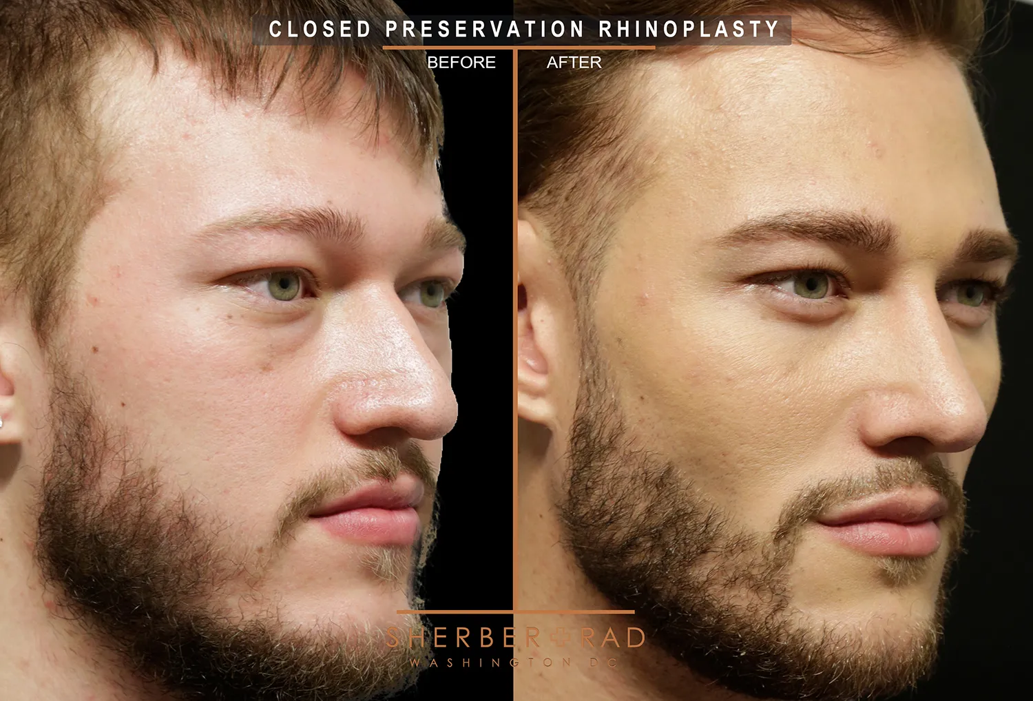 Facial Optimization before and after photos by Sherber and Rad in Washington DC