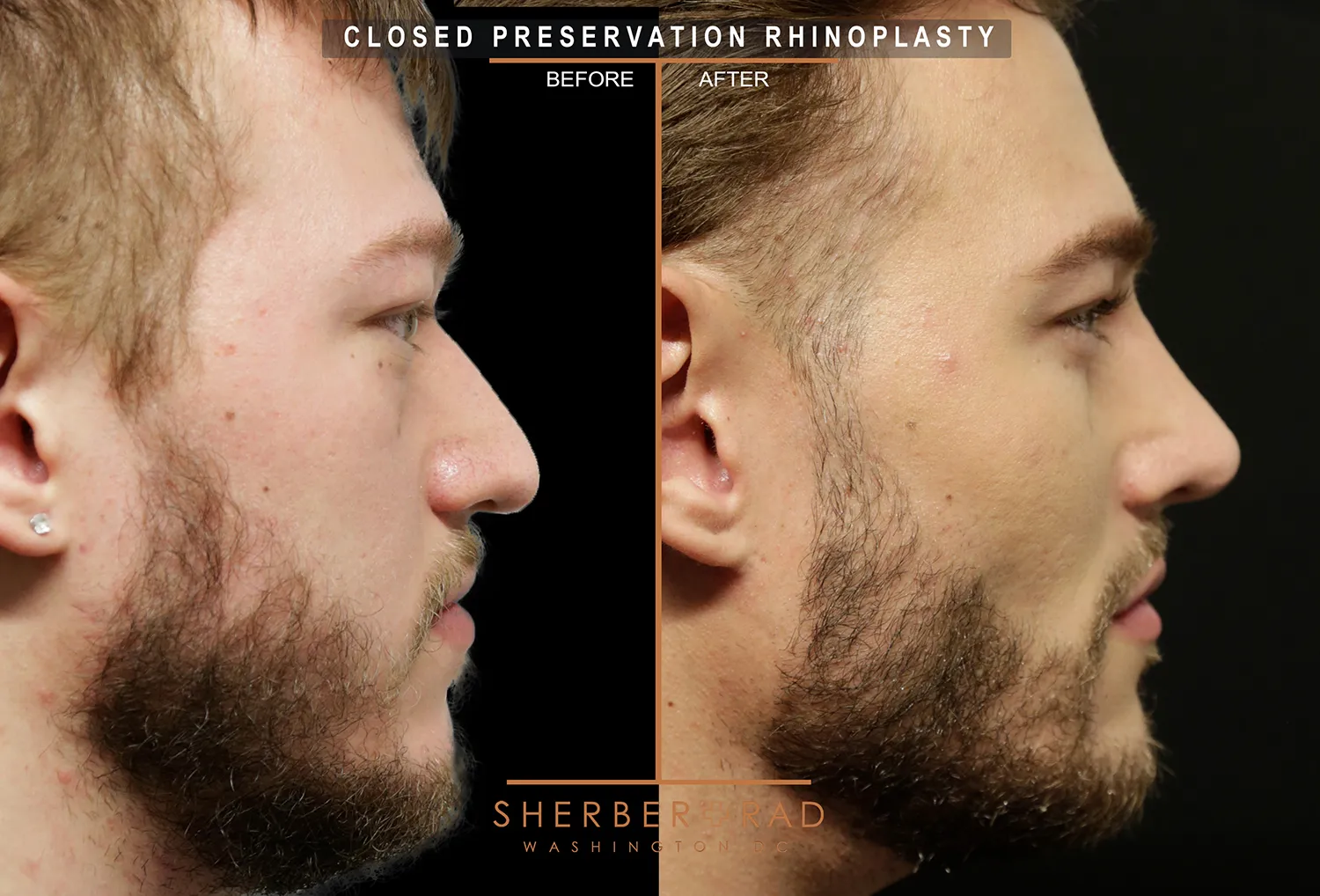 Facial Optimization before and after photos by Sherber and Rad in Washington DC