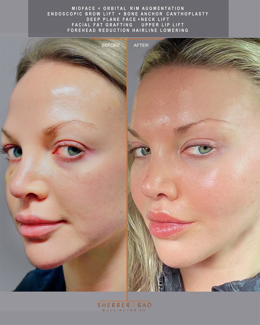 Deep Plane Facelift before and after photos by Sherber and Rad in Washington