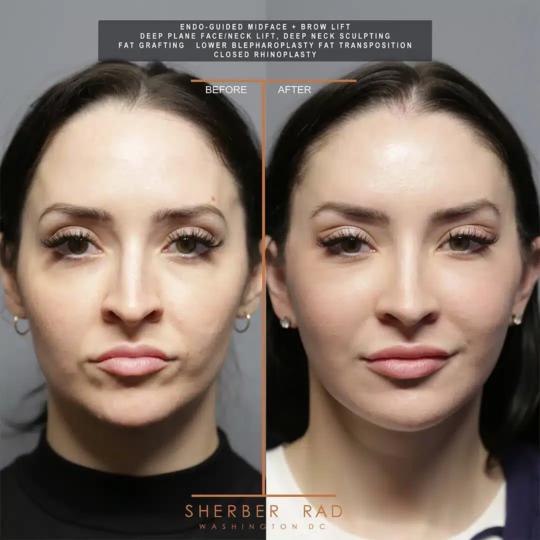 Deep Plane Facelift before and after photos by Sherber and Rad in Washington