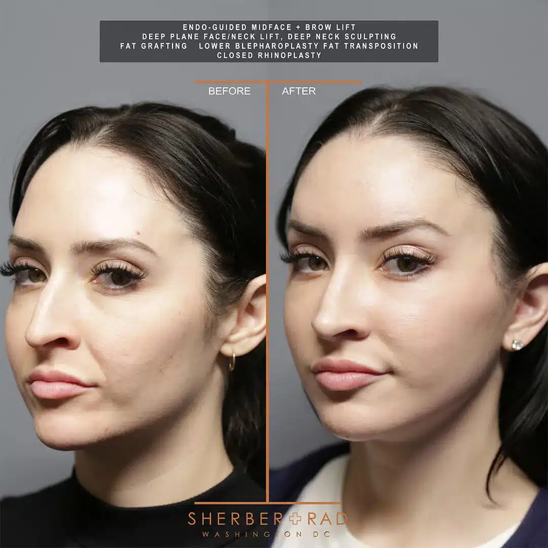Deep Plane Facelift before and after photos by Sherber and Rad in Washington