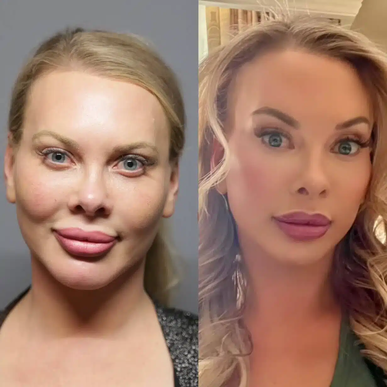 Deep Plane Facelift before and after photos by Sherber and Rad in Washington