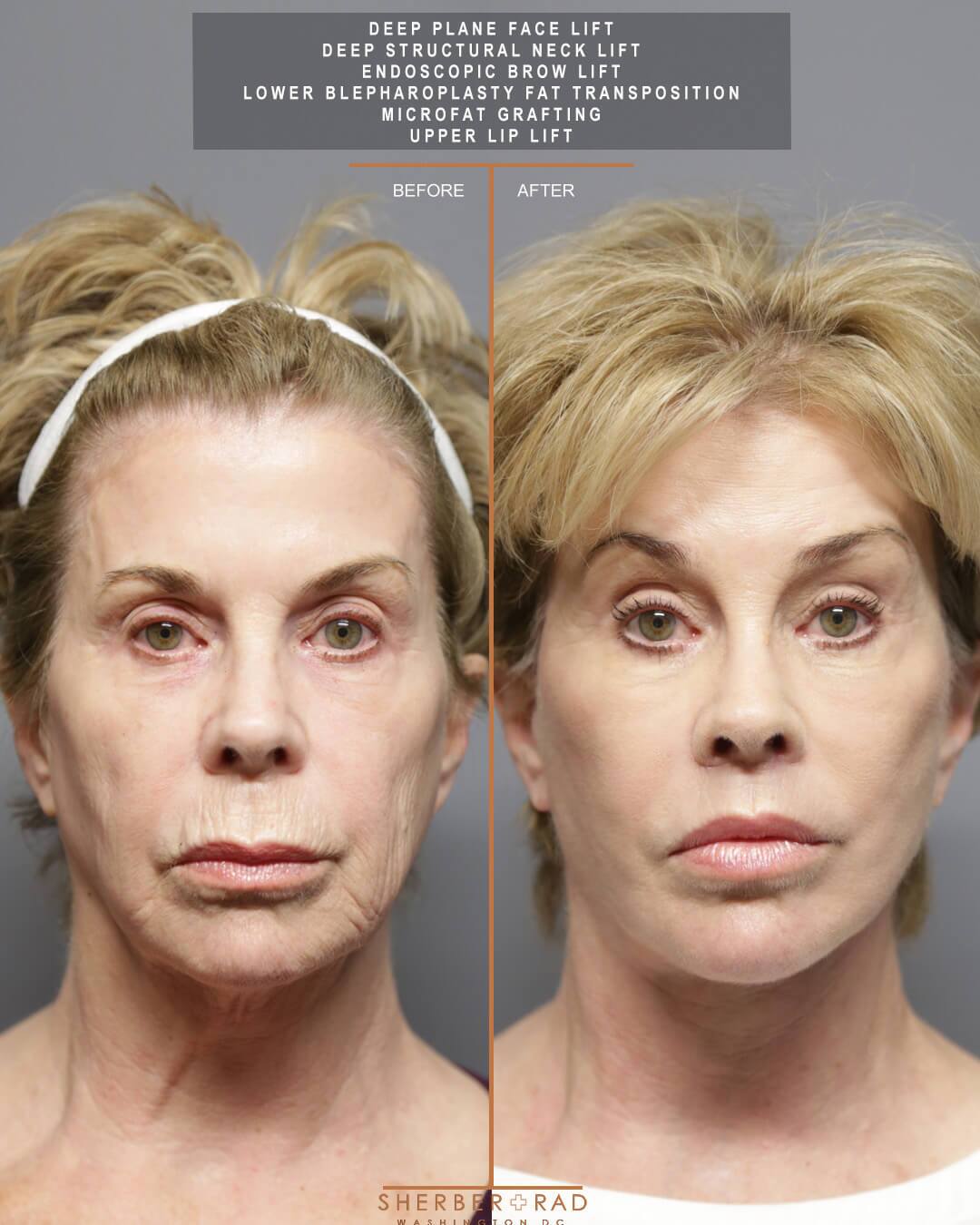 Facial Optimization before and after photos by Sherber and Rad in Washington