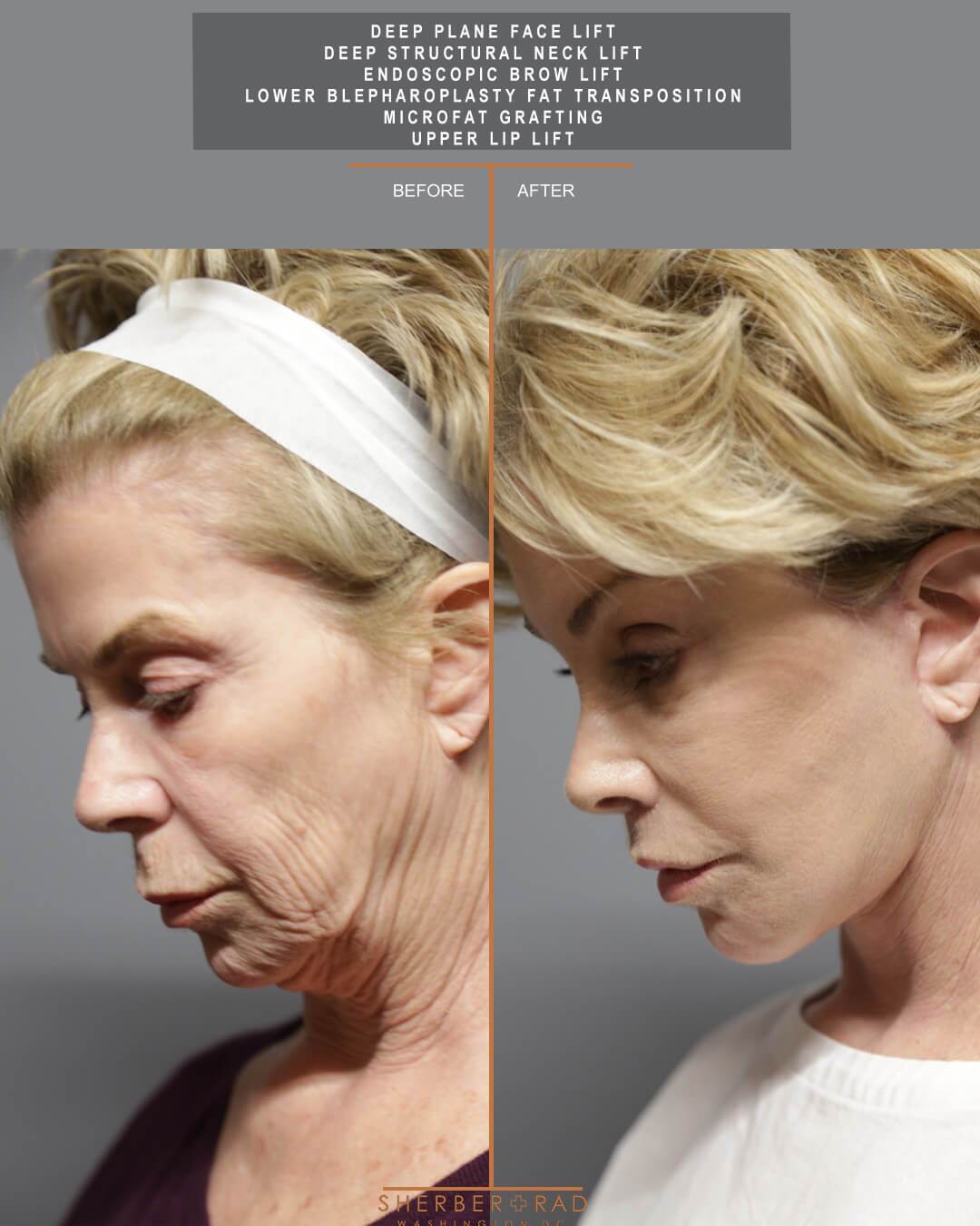 Facial Optimization before and after photos by Sherber and Rad in Washington