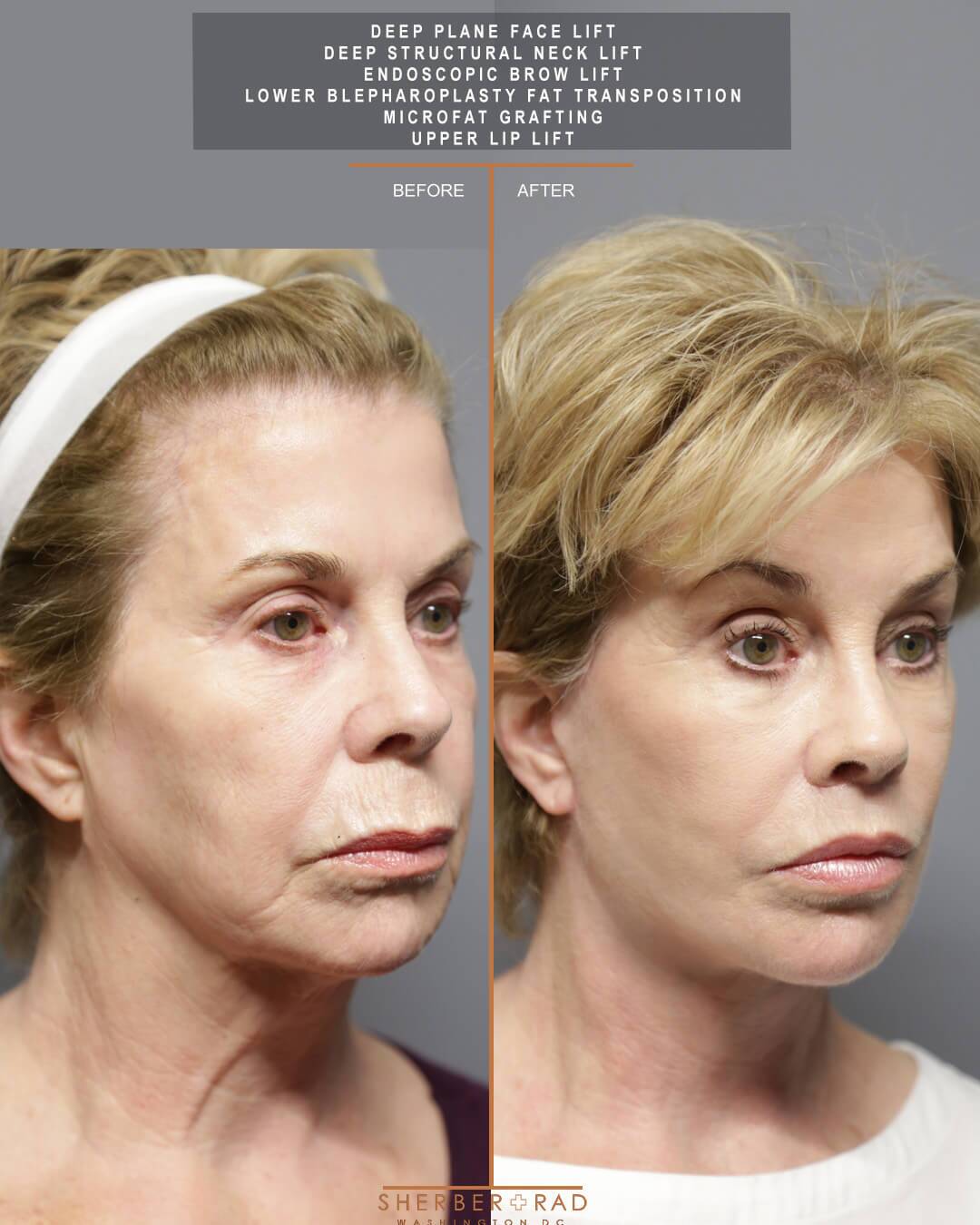 Facial Optimization before and after photos by Sherber and Rad in Washington