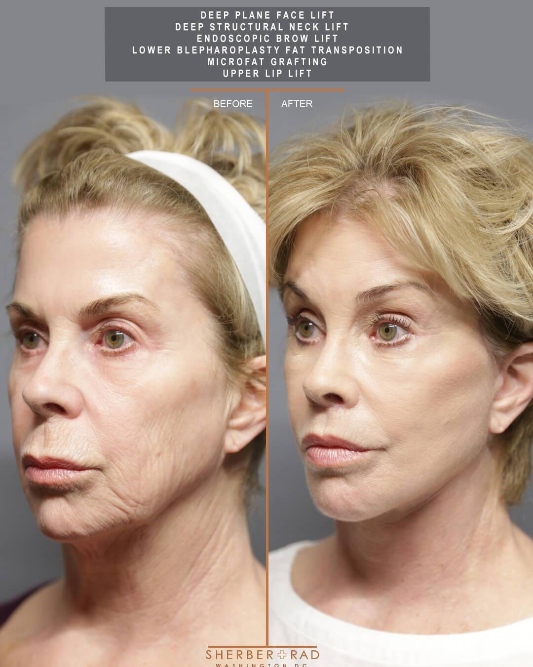 Facial Optimization before and after photos by Sherber and Rad in Washington