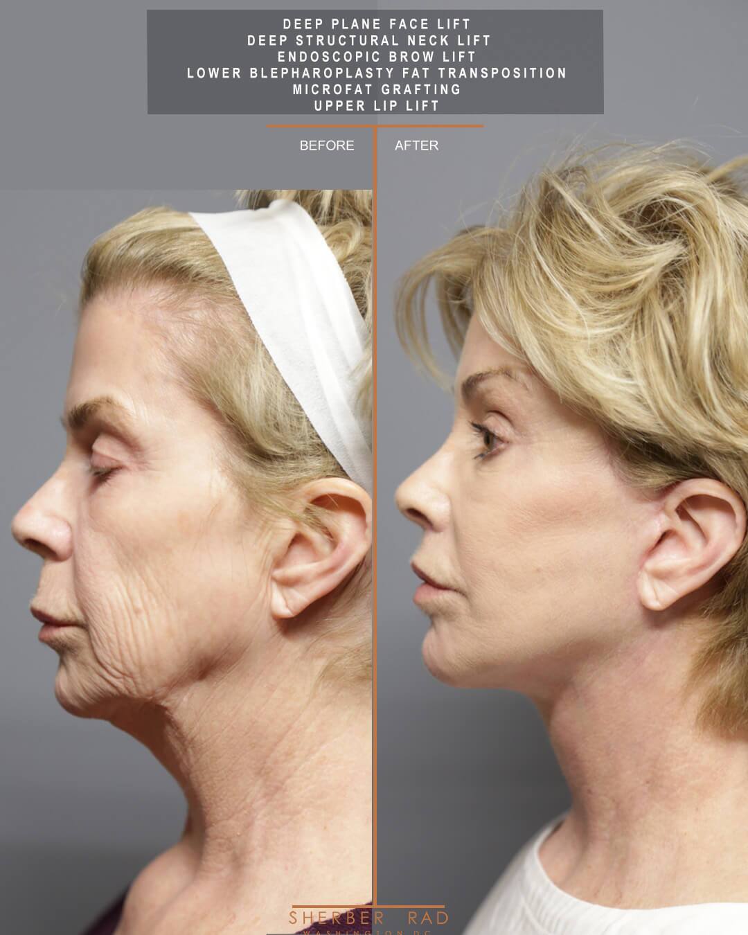 Facial Optimization before and after photos by Sherber and Rad in Washington