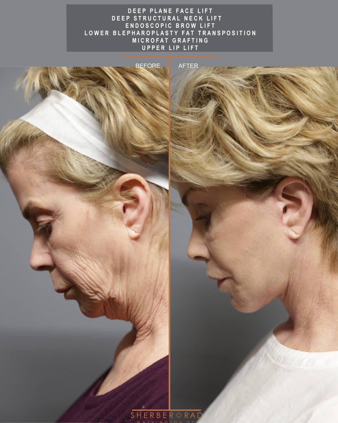 Facial Optimization before and after photos by Sherber and Rad in Washington