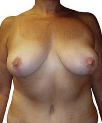 Breast Lift + Reduction