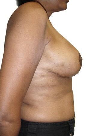 Breast Lift + Reduction