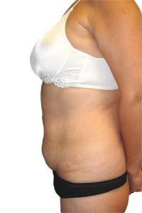 Tummy Tuck + Liposuction