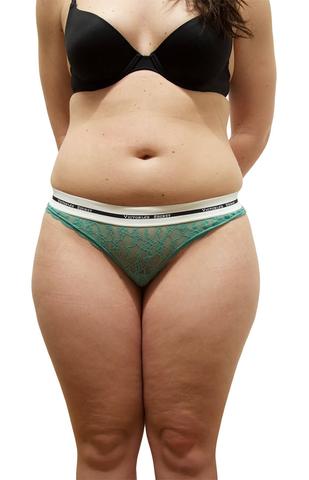 Tummy Tuck + Liposuction