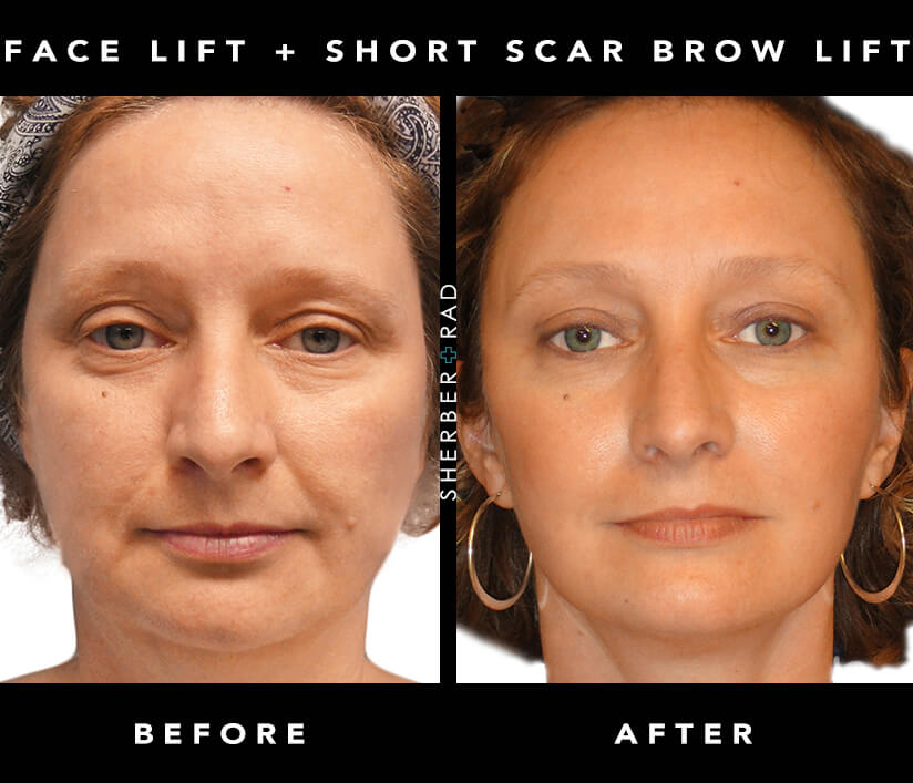57 HQ Pictures Cat Eye Lift Surgery Cost / Undereye Bag Removal
