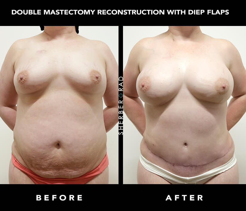 Breast Cancer Reconstruction in Washington DC