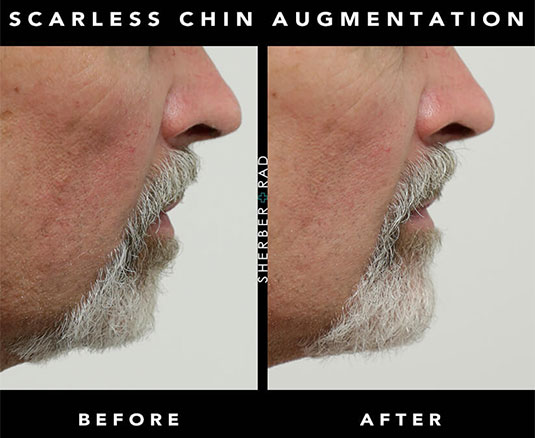 Chin Augmentation