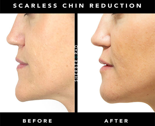 Chin Reduction