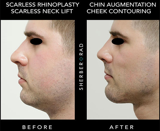 Rhinoplasty and Chin Augmentation