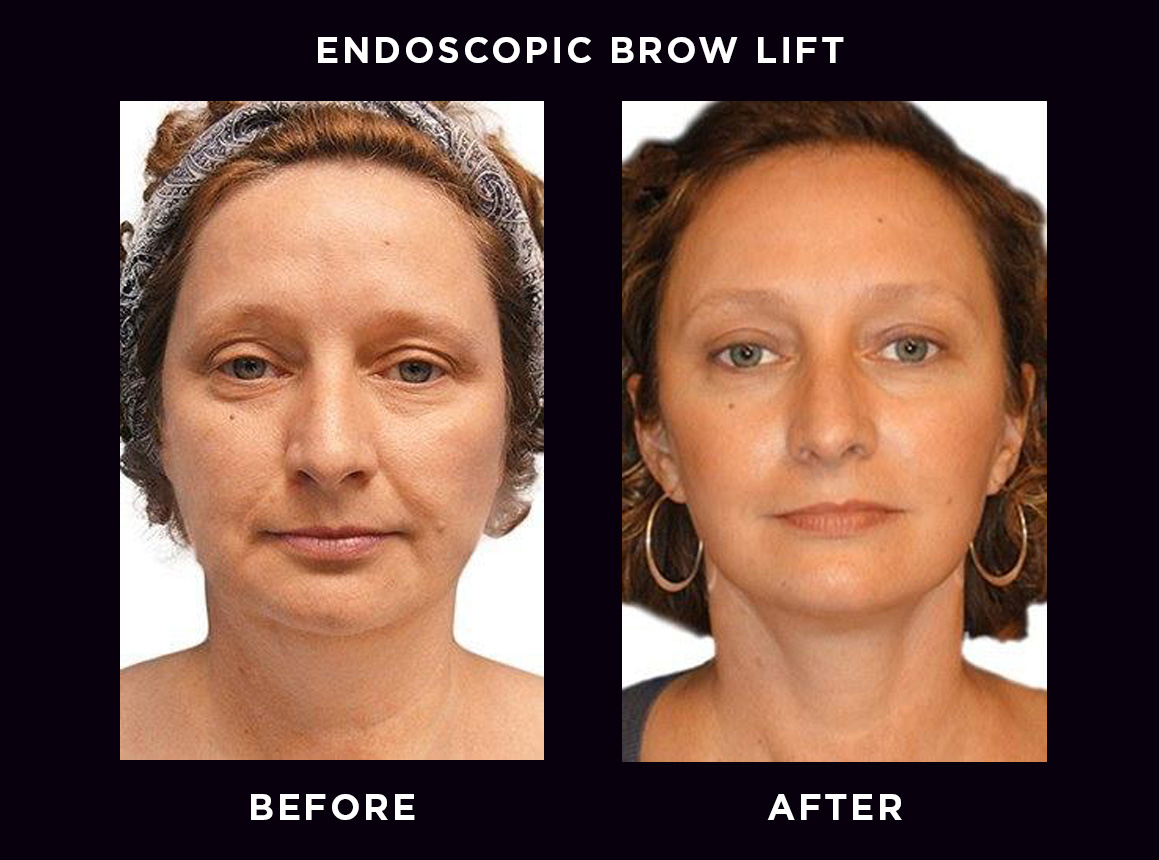 Eyebrow Thread Lift  Costs, Duration and Side Effects - Rahya Clinic