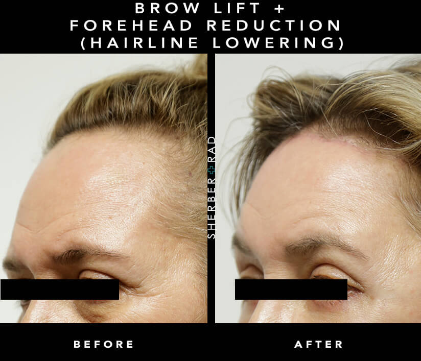 Forehead Redux Gallery Image 1